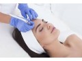 plasma-skin-resurfacing-aurora-co-small-0